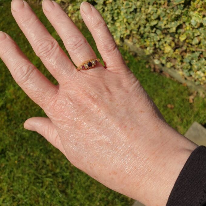 Edwardian Ruby and Diamond Ring in 18ct Gold